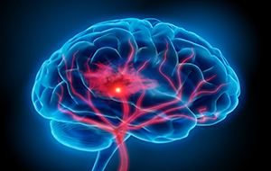http://insights.bio/cell-and-gene-therapy-insights/wp-content/uploads/sites/2/2015/07/Stroke.png